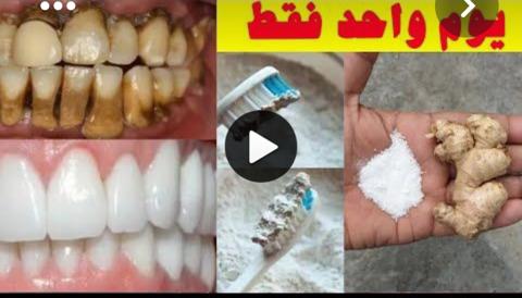 وصفة طبيعية لعلاج اصفرار الاسنان 