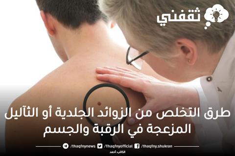 تجربتي مع الزوائد الجلدية