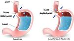 ما هو الحل النهائي لعلاج لارتجاع المريء