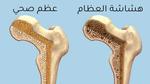 التخلص من هشاشة العظام وفقدان الوزن وعلاج