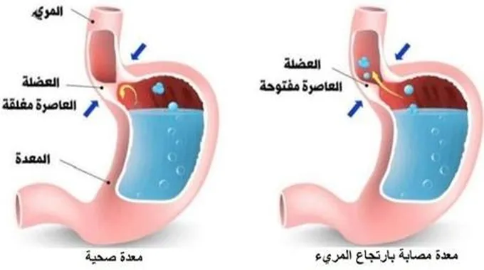 ما هو الحل النهائي لعلاج لارتجاع المريء