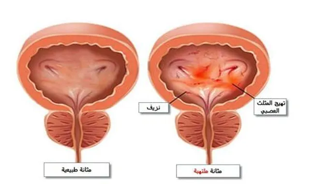 وصفات طبيعية لعلاج حرقان البول وأبرز الأسباب