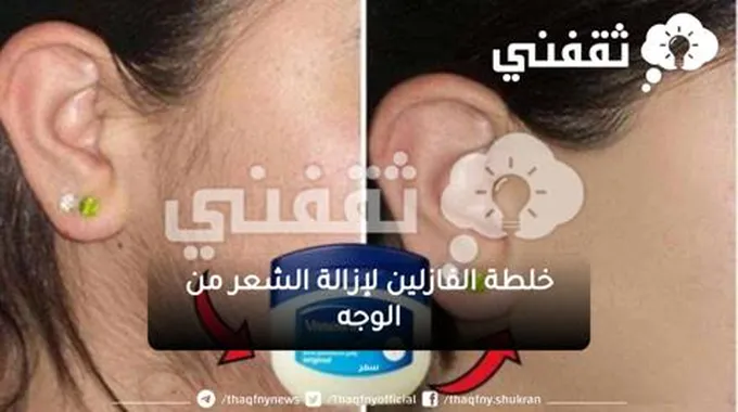 لو عايزة تشيلي شعر الوجه الزائد بدون ألم