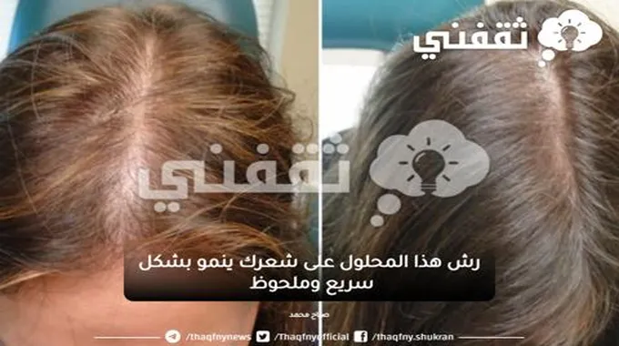 رش هذا المحلول على شعرك ينمو بشكل سريع وملحوظ