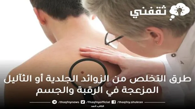 طرق التخلص من الزوائد الجلدية أو الثآليل المزعجة في الرقبة والجسم