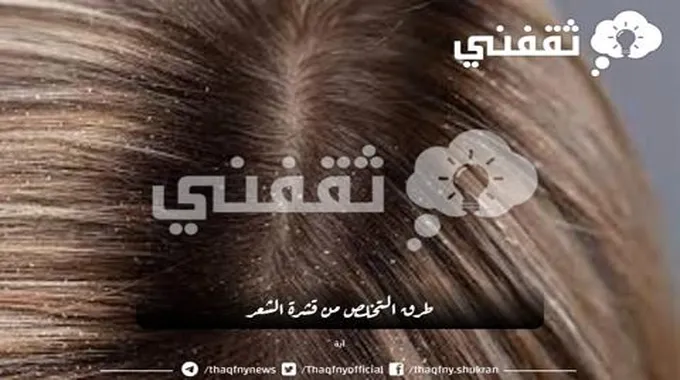 طرق طبيعية للتخلص من قشرة الشعر