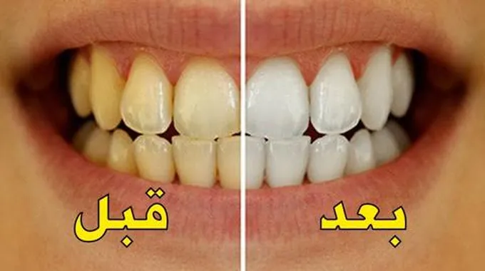 طرق تبييض الأسنان في المنزل باستخدام مكونات