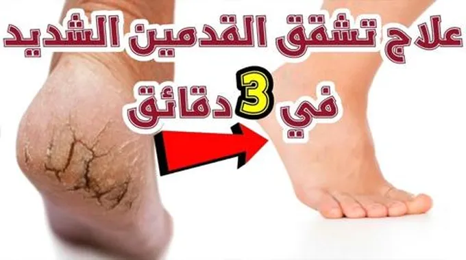 بشمعة واحدة فقط تخلصي من تشققات الأقدام والجلد