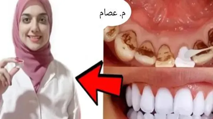 ما هي أسرع طريقة لتبييض الأسنان ؟ وصفات فعالة