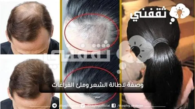 مكون صاروخي وفعال لتكثيف وتطويل الشعر وملئ