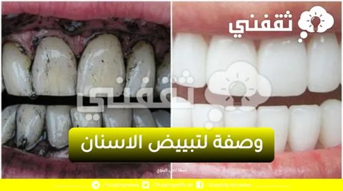 أفضل وصفة لتبييض الاسنان بسرعة للحصول على