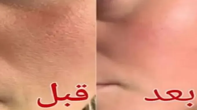 مفعولها مضمون 100%.. أسرع طريقة للتخلص من